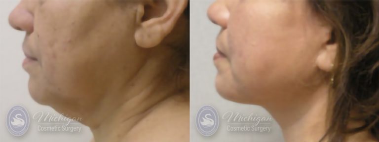 Facelift/Necklift Before and After Photo by Dr. Awada in Southfield Michigan