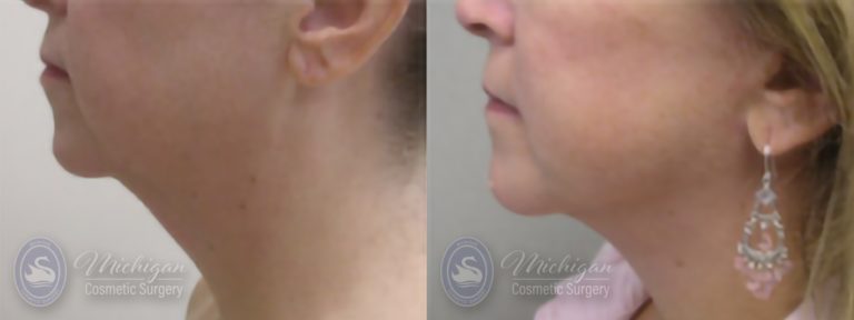 Facelift/Necklift Before and After Photo by Dr. Awada in Southfield Michigan