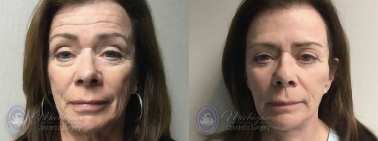 Facelift/Necklift Before and After Photo by Dr. Awada in Southfield Michigan