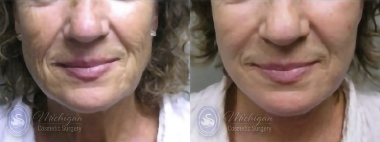 Facelift/Necklift Before and After Photo by Dr. Awada in Southfield Michigan
