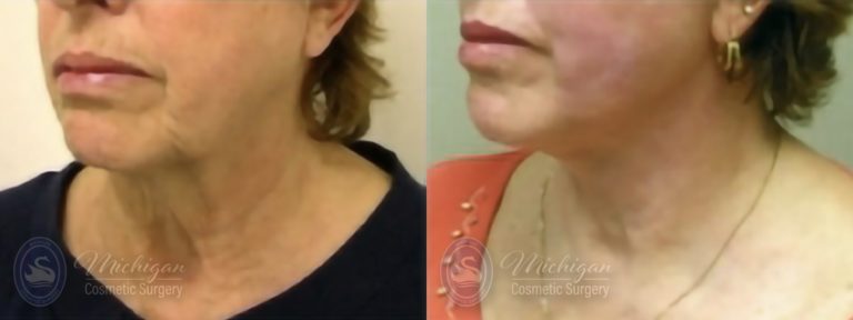 Facelift/Necklift Before and After Photo by Dr. Awada in Southfield Michigan