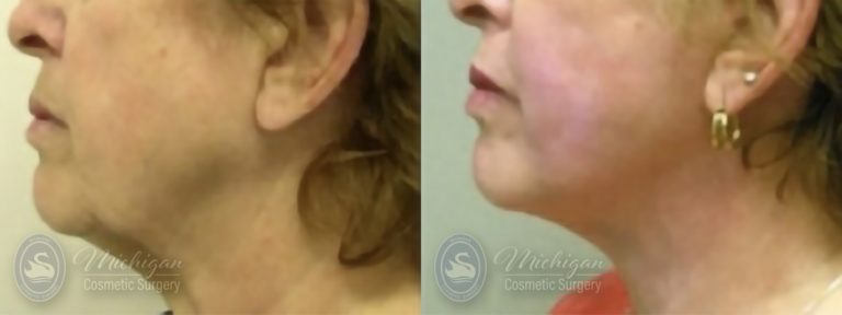 Facelift/Necklift Before and After Photo by Dr. Awada in Southfield Michigan