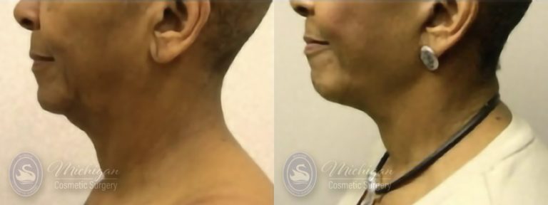 Facelift/Necklift Before and After Photo by Dr. Awada in Southfield Michigan