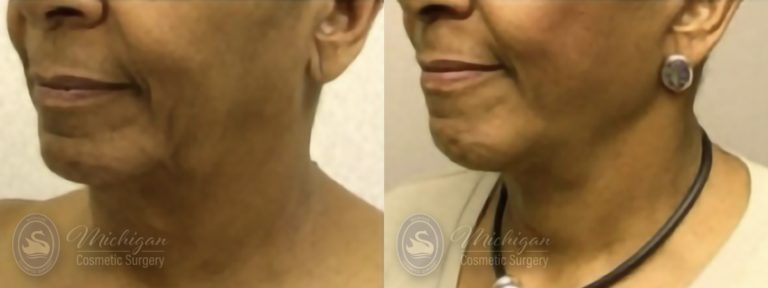 Facelift/Necklift Before and After Photo by Dr. Awada in Southfield Michigan