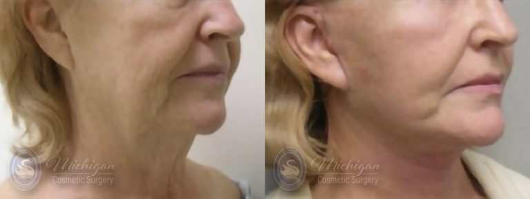 Facelift/Necklift Before and After Photo by Dr. Awada in Southfield Michigan