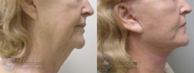 Facelift/Necklift Before and After Photo by Dr. Awada in Southfield Michigan