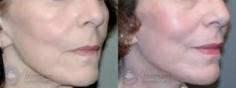 Facelift/Necklift Before and After Photo by Dr. Awada in Southfield Michigan