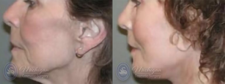 Facelift/Necklift Before and After Photo by Dr. Awada in Southfield Michigan