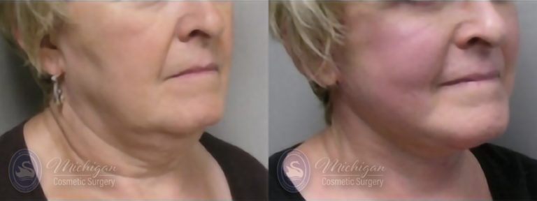 Facelift/Necklift Before and After Photo by Dr. Awada in Southfield Michigan