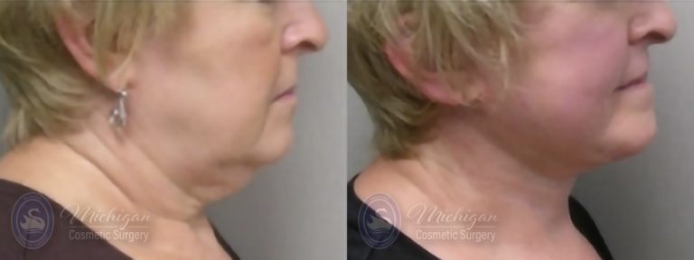 Facelift/Necklift Before and After Photo by Dr. Awada in Southfield Michigan