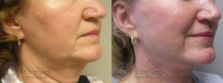 Facelift/Necklift Before and After Photo by Dr. Awada in Southfield Michigan