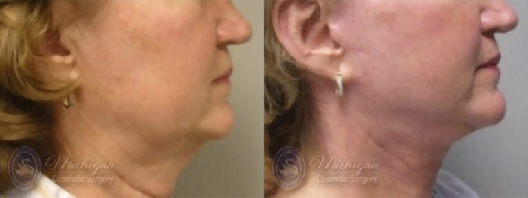 Facelift/Necklift Before and After Photo by Dr. Awada in Southfield Michigan