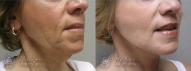 Facelift/Necklift Before and After Photo by Dr. Awada in Southfield Michigan