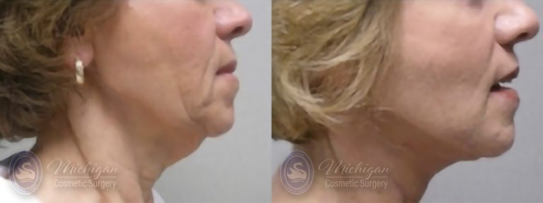 Facelift/Necklift Before and After Photo by Dr. Awada in Southfield Michigan