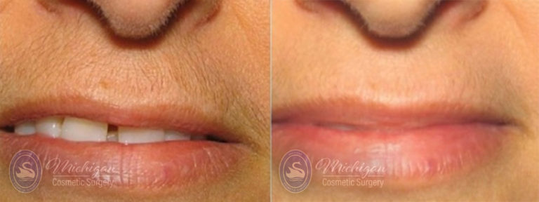 Laser Hair Removal Before and After Photo by Dr. Awada in Southfield Michigan