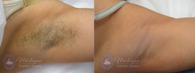 Laser Hair Removal Before and After Photo by Dr. Awada in Southfield Michigan