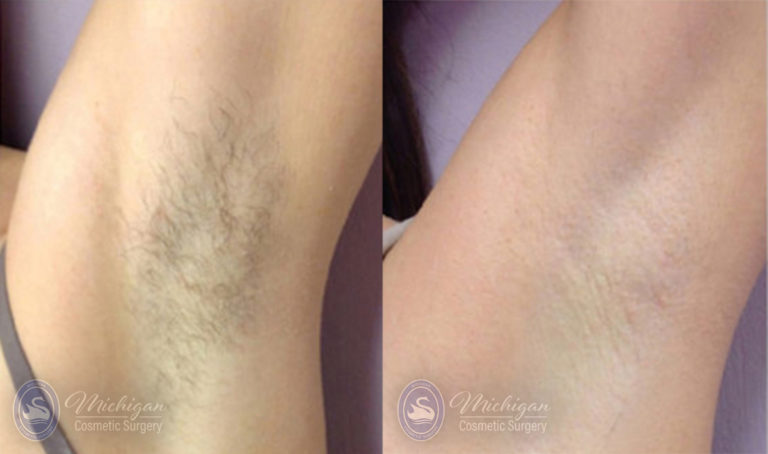 Laser Hair Removal Before and After Photo by Dr. Awada in Southfield Michigan