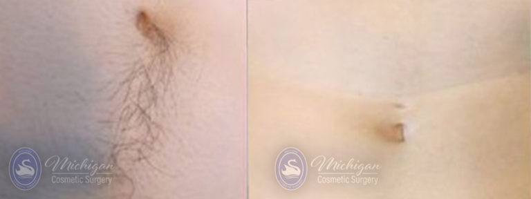 Laser Hair Removal Before and After Photo by Dr. Awada in Southfield Michigan