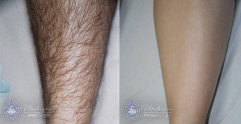 Laser Hair Removal Before and After Photo by Dr. Awada in Southfield Michigan