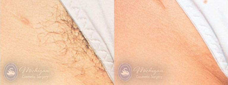 Laser Hair Removal Before and After Photo by Dr. Awada in Southfield Michigan