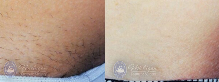 Laser Hair Removal Before and After Photo by Dr. Awada in Southfield Michigan