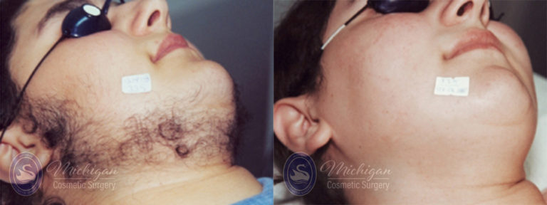 Laser Hair Removal Before and After Photo by Dr. Awada in Southfield Michigan