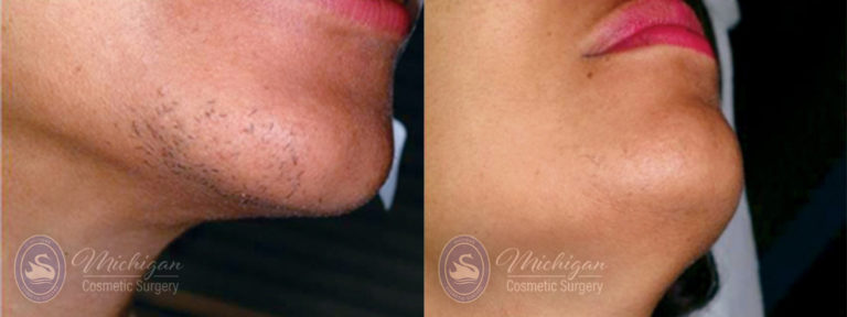 Laser Hair Removal Before and After Photo by Dr. Awada in Southfield Michigan