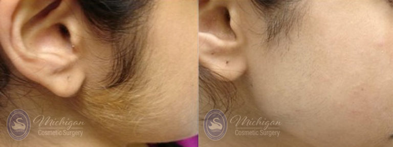 Laser Hair Removal Before and After Photo by Dr. Awada in Southfield Michigan