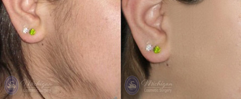 Laser Hair Removal Before and After Photo by Dr. Awada in Southfield Michigan