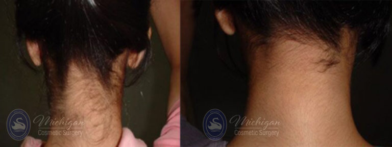 Laser Hair Removal Before and After Photo by Dr. Awada in Southfield Michigan