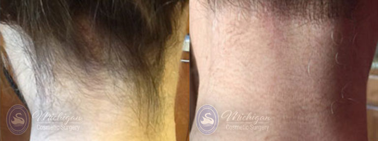 Laser Hair Removal Before and After Photo by Dr. Awada in Southfield Michigan