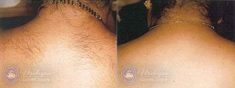 Laser Hair Removal Before and After Photo by Dr. Awada in Southfield Michigan