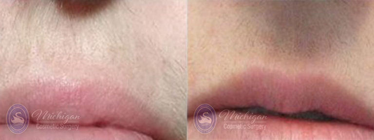 Laser Hair Removal Before and After Photo by Dr. Awada in Southfield Michigan