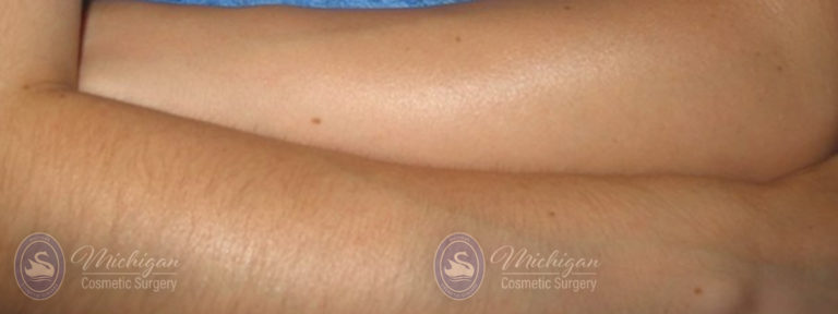 Laser Hair Removal Before and After Photo by Dr. Awada in Southfield Michigan