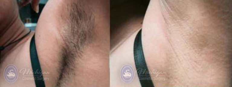 Laser Hair Removal Before and After Photo by Dr. Awada in Southfield Michigan