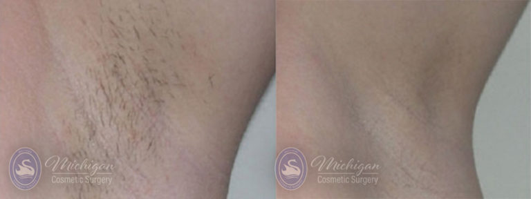 Laser Hair Removal Before and After Photo by Dr. Awada in Southfield Michigan