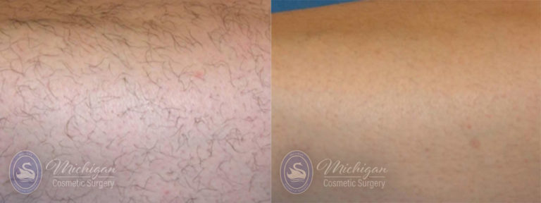 Laser Hair Removal Before and After Photo by Dr. Awada in Southfield Michigan
