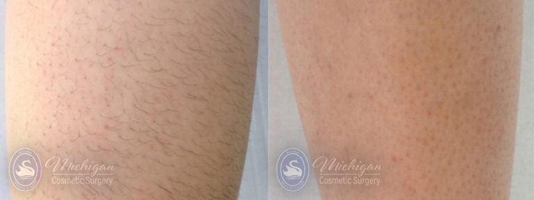Laser Hair Removal Before and After Photo by Dr. Awada in Southfield Michigan