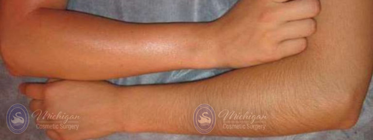 Laser Hair Removal Before and After Photo by Dr. Awada in Southfield Michigan