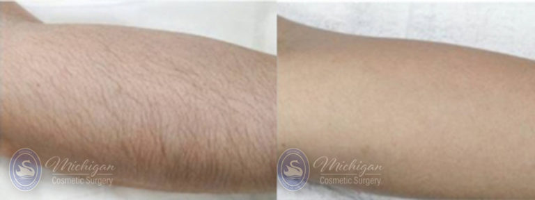 Laser Hair Removal Before and After Photo by Dr. Awada in Southfield Michigan