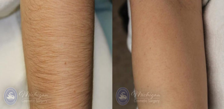 Laser Hair Removal Before and After Photo by Dr. Awada in Southfield Michigan