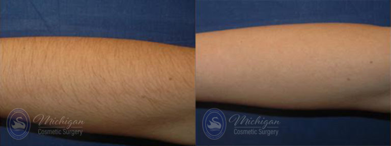Laser Hair Removal Before and After Photo by Dr. Awada in Southfield Michigan