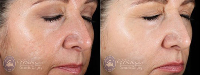 Laser Scar Removal Before and After Photo by Dr. Awada in Southfield Michigan