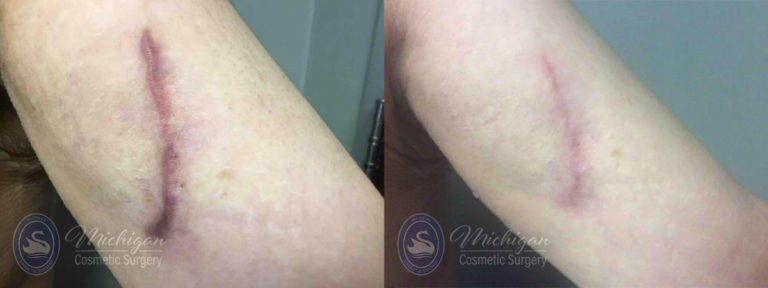 Laser Scar Removal Before and After Photo by Dr. Awada in Southfield Michigan