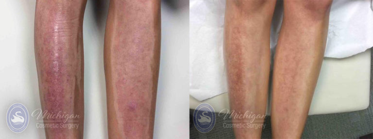 Laser Scar Removal Before and After Photo by Dr. Awada in Southfield Michigan