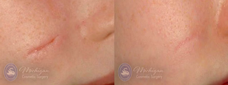 Laser Scar Removal Before and After Photo by Dr. Awada in Southfield Michigan