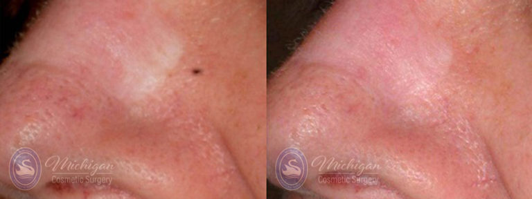 Laser Scar Removal Before and After Photo by Dr. Awada in Southfield Michigan