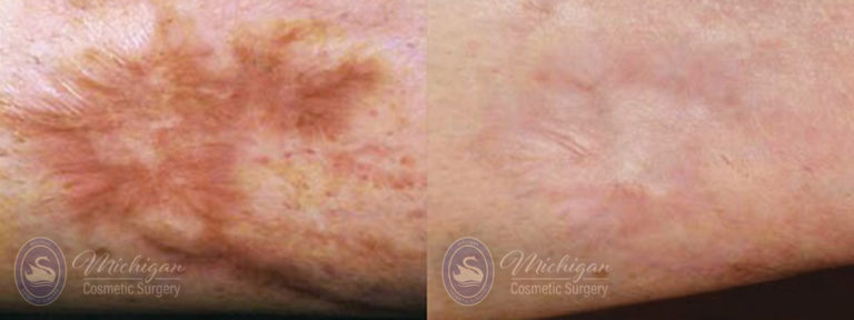 Laser Scar Removal Before and After Photo by Dr. Awada in Southfield Michigan
