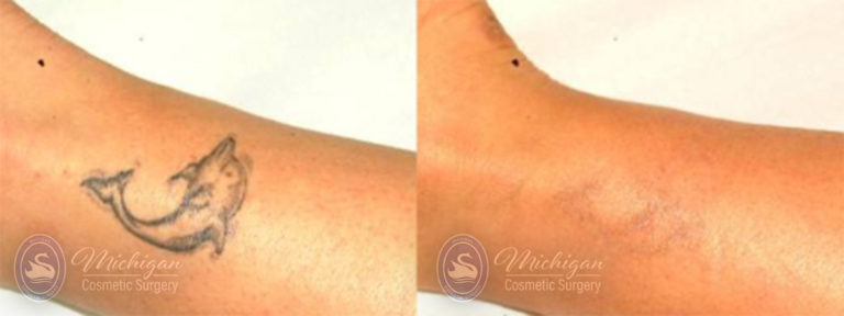 Laser Tattoo Removal Before and After Photo by Dr. Awada in Southfield Michigan