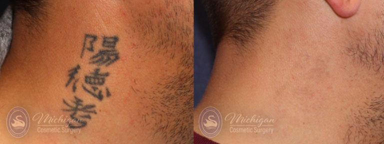Laser Tattoo Removal Before and After Photo by Dr. Awada in Southfield Michigan